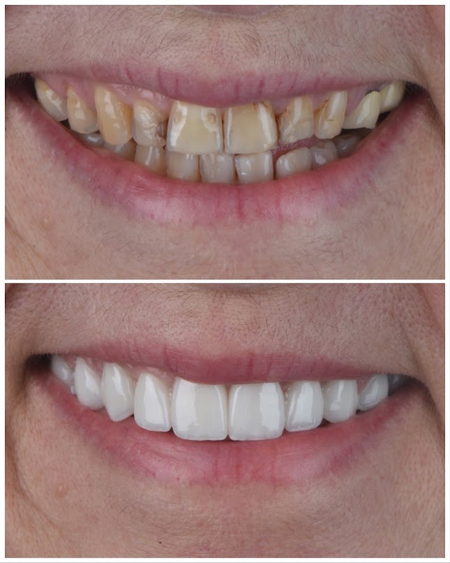 Porcelain Veneers In Miami FL Sharp Dentistry Associates