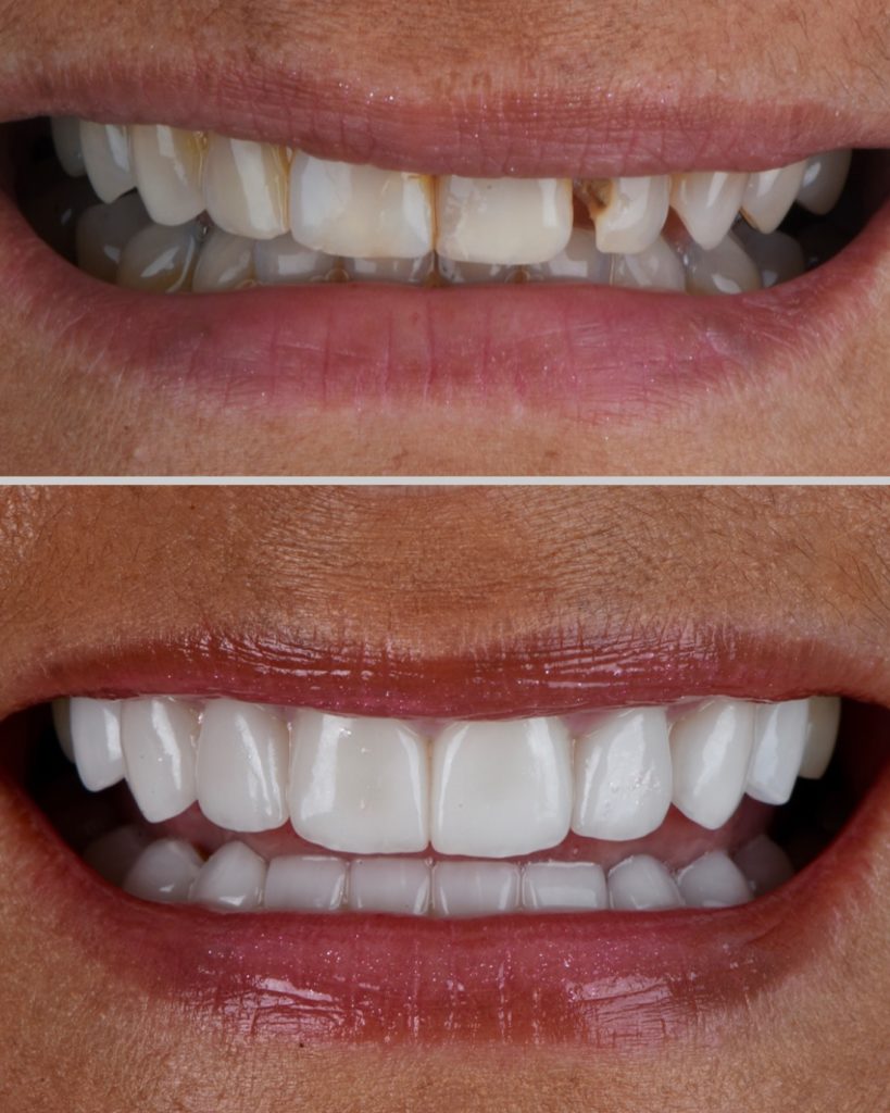 Porcelain Veneers A Far Better Procedure To Enhance Aesthetics