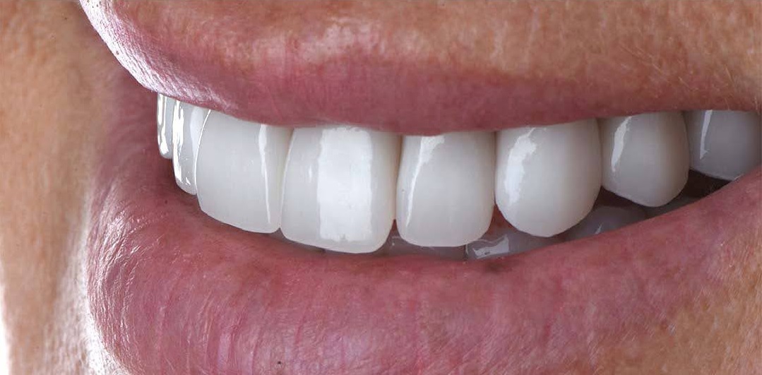 After Dental Implants Image