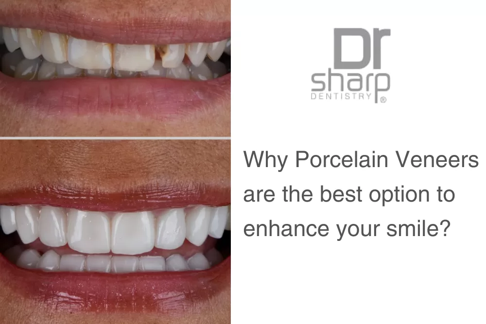 Veneers Miami