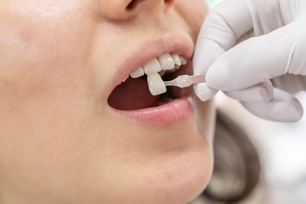 quick veneers Miami