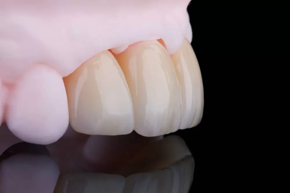 Dental Crowns in Miami