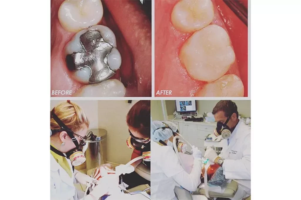 dental amalgam mercury