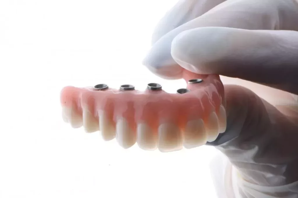 dental implants benefits