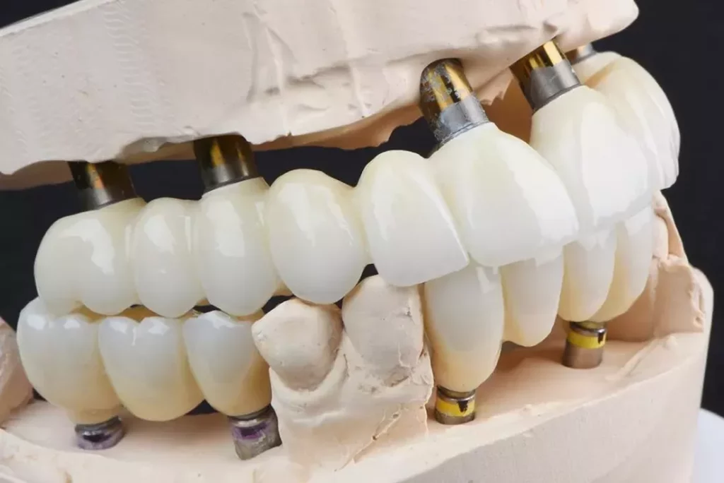 all on four dental implants