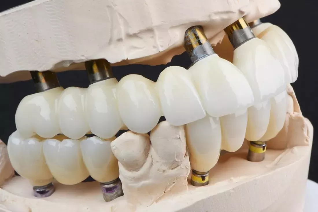 all on four dental implants