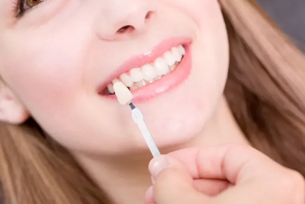 cosmetic veneers Miami