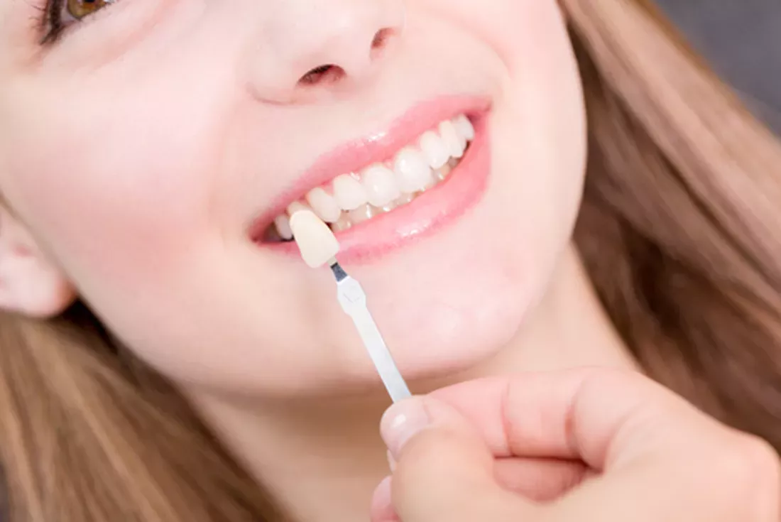 cosmetic veneers Miami
