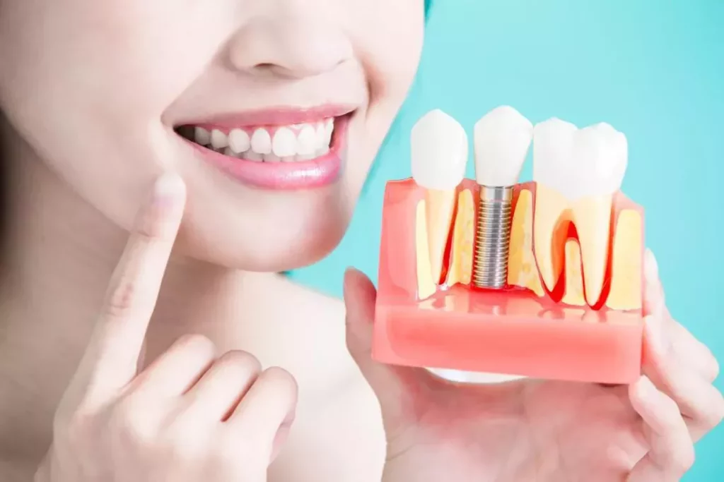 Know about Dental Implants