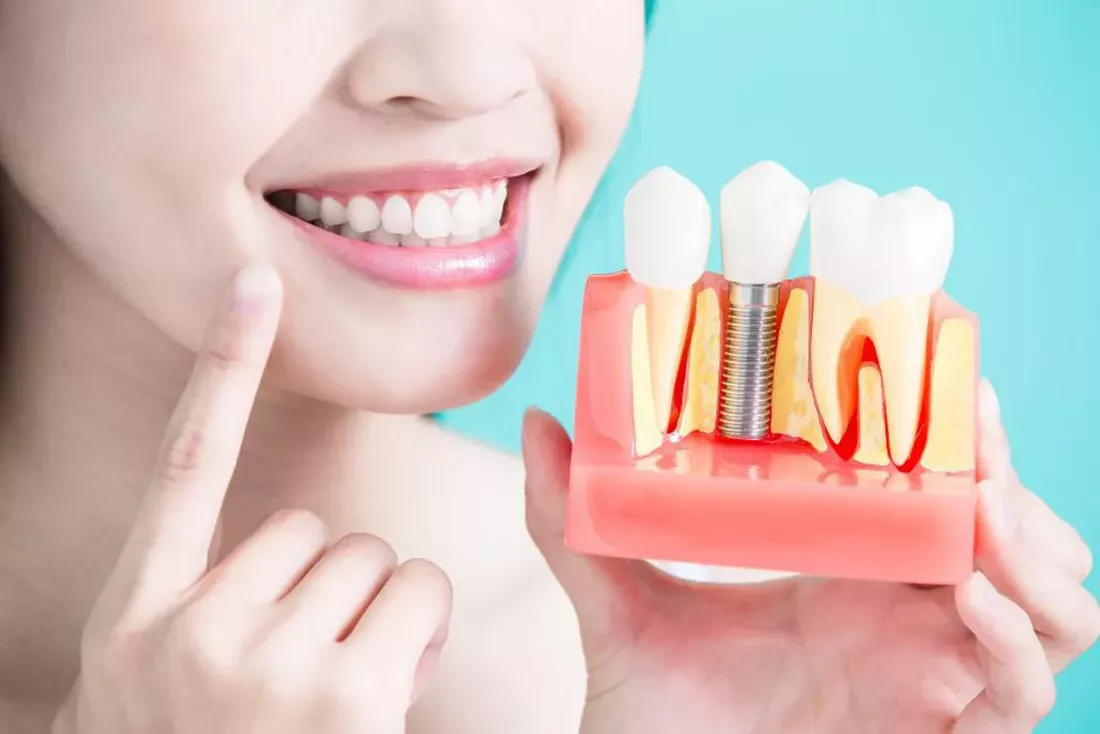 Know about Dental Implants