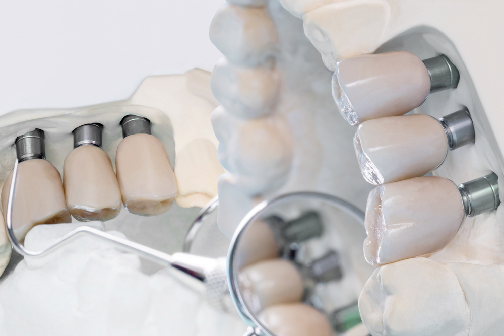 Dental Implants