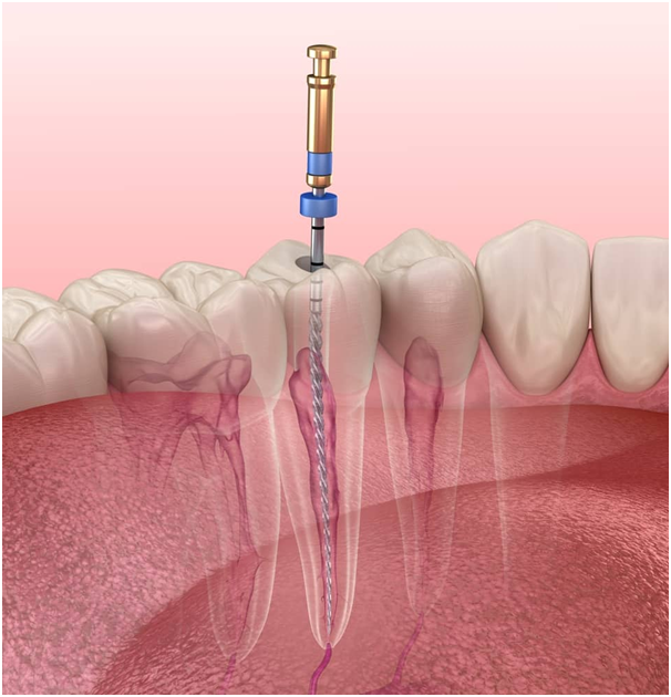 root canal treatment