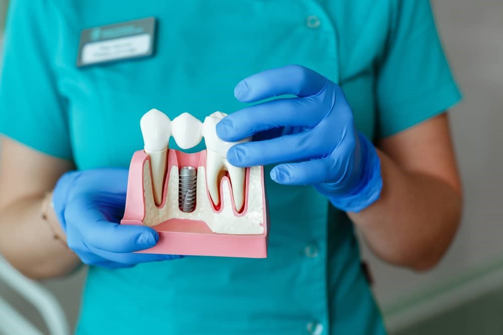 dental implants benefits