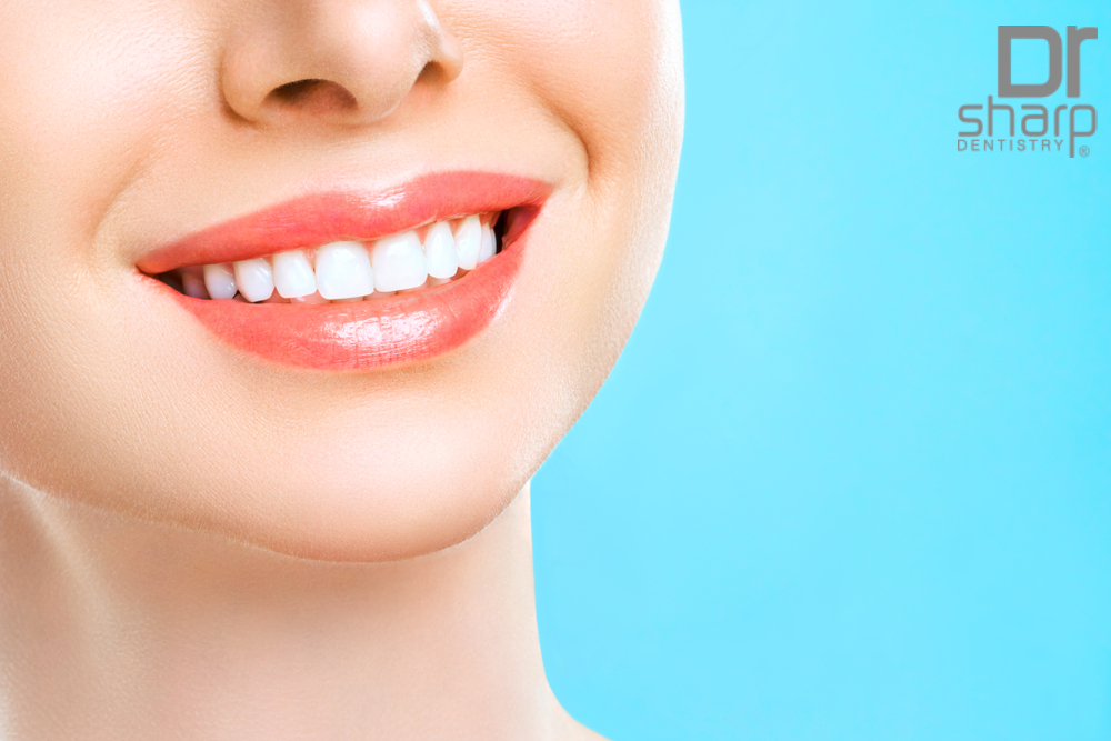 Dental Veneers