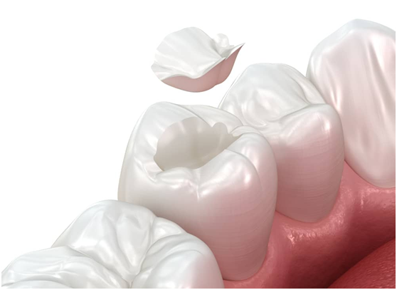 composite fillings