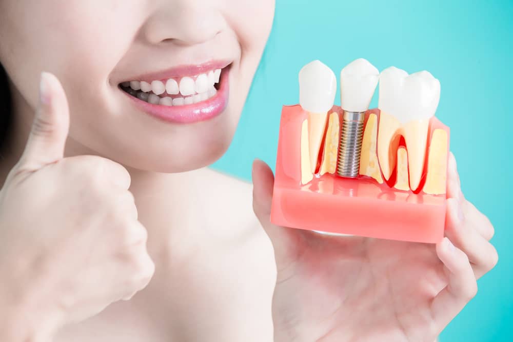 bone grafting before dental implants