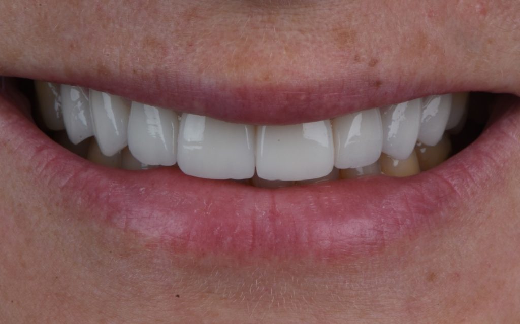 after treatment