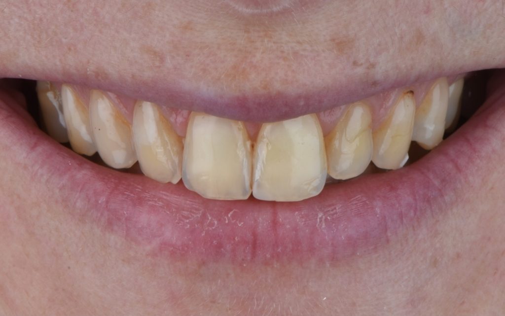 before treatment