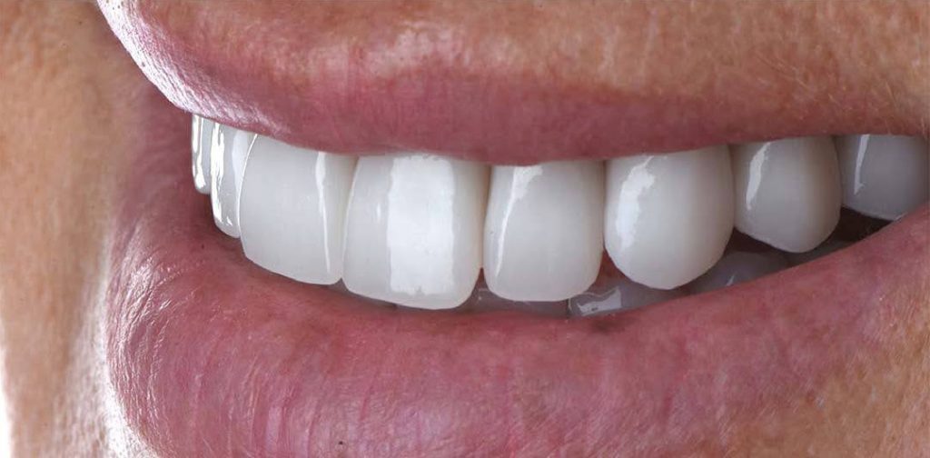 After Dental Implants Image