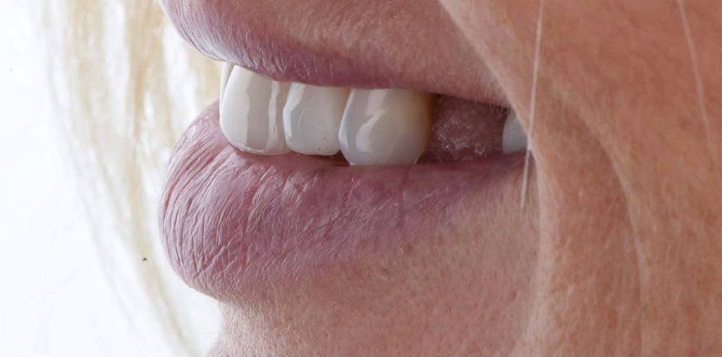 Before Dental Implants Image