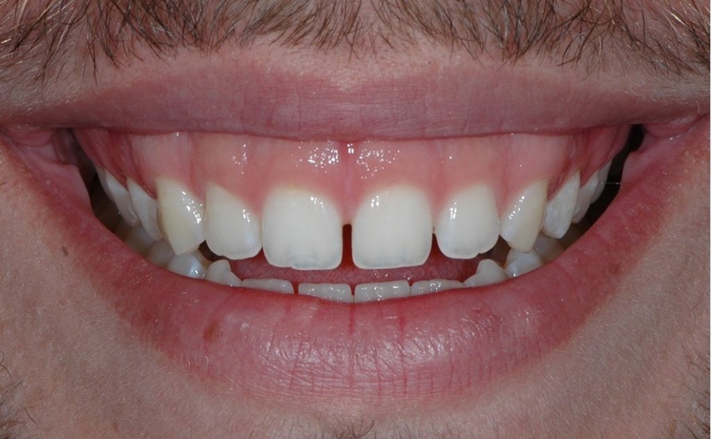before treatment smile
