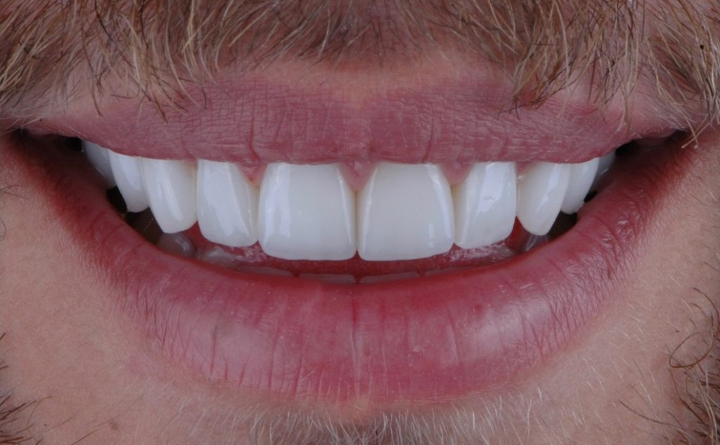 after treatment smile