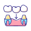 Dental Crown