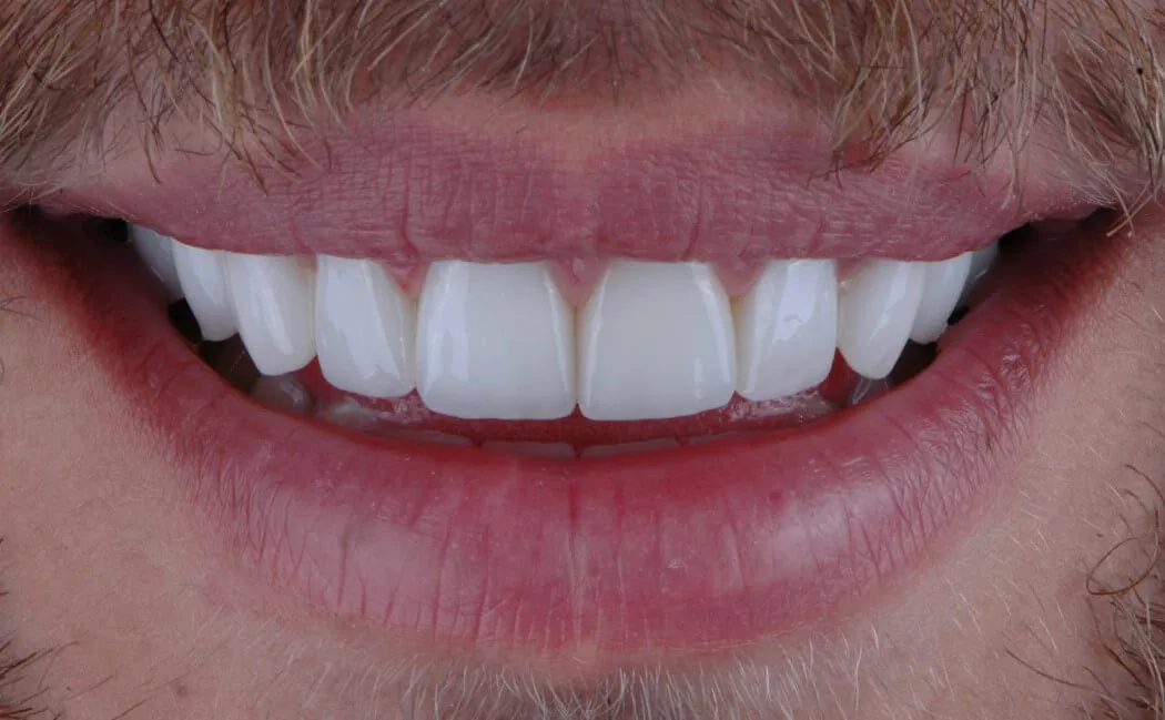 Porcelain Veneers Fix