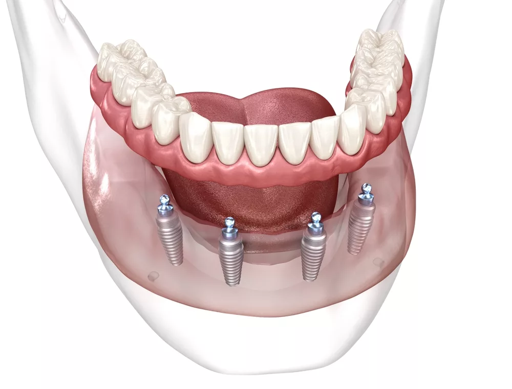 All-on-4 dental implants procedure diagram