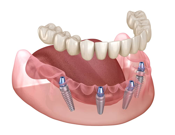 All-on-4 dental implant illustration