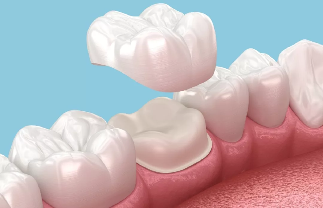 Dental Crowns in Miami