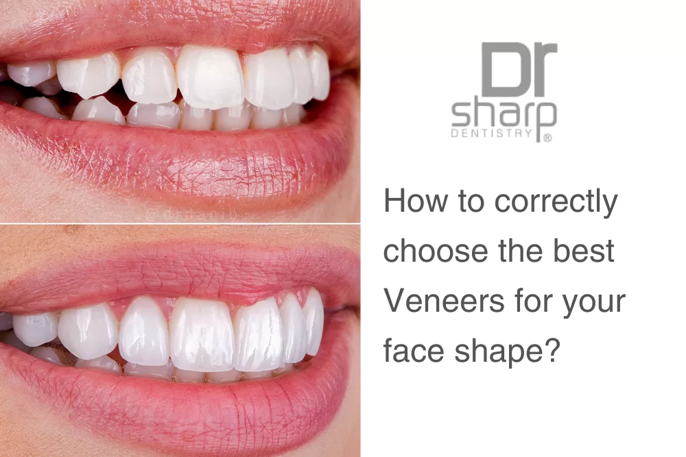 veneers in Miami