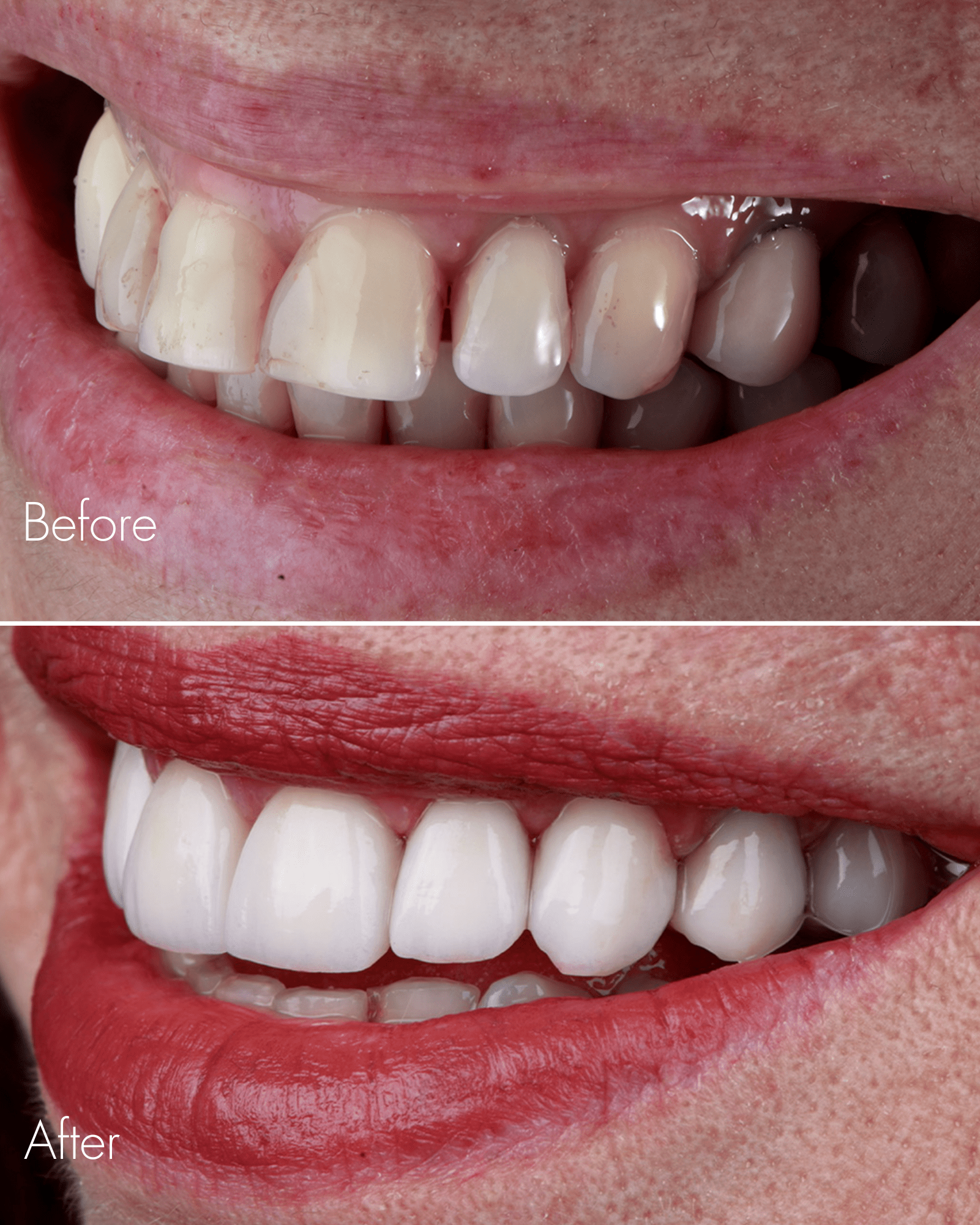 Before and After Teeth Whitening Treatment