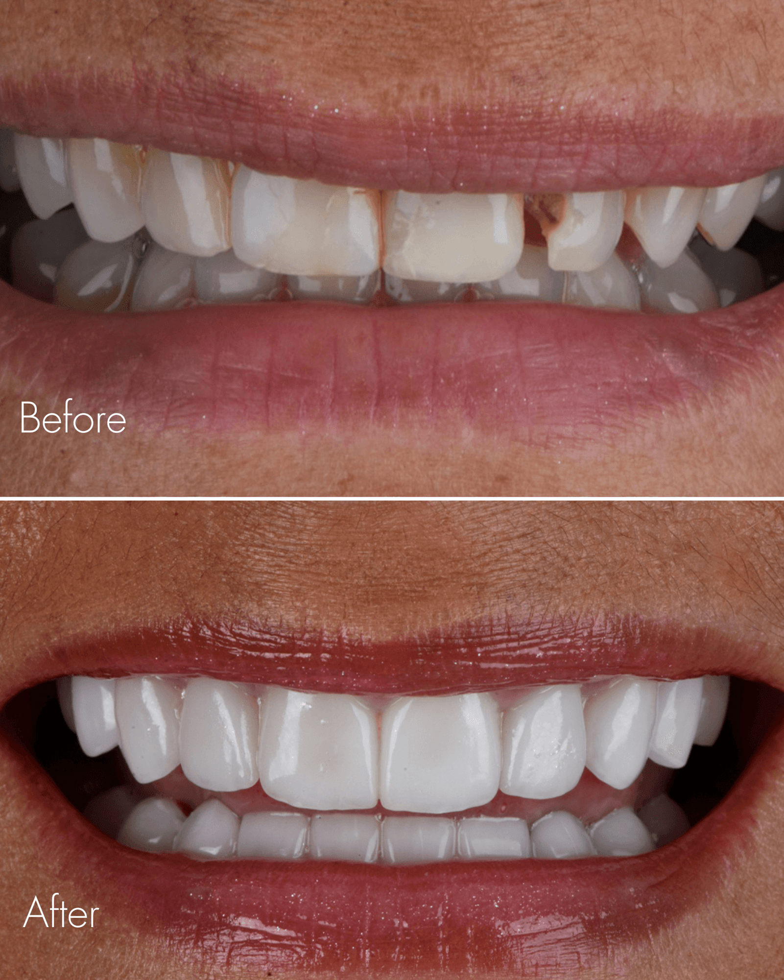 Dental Before After Smile Makeover