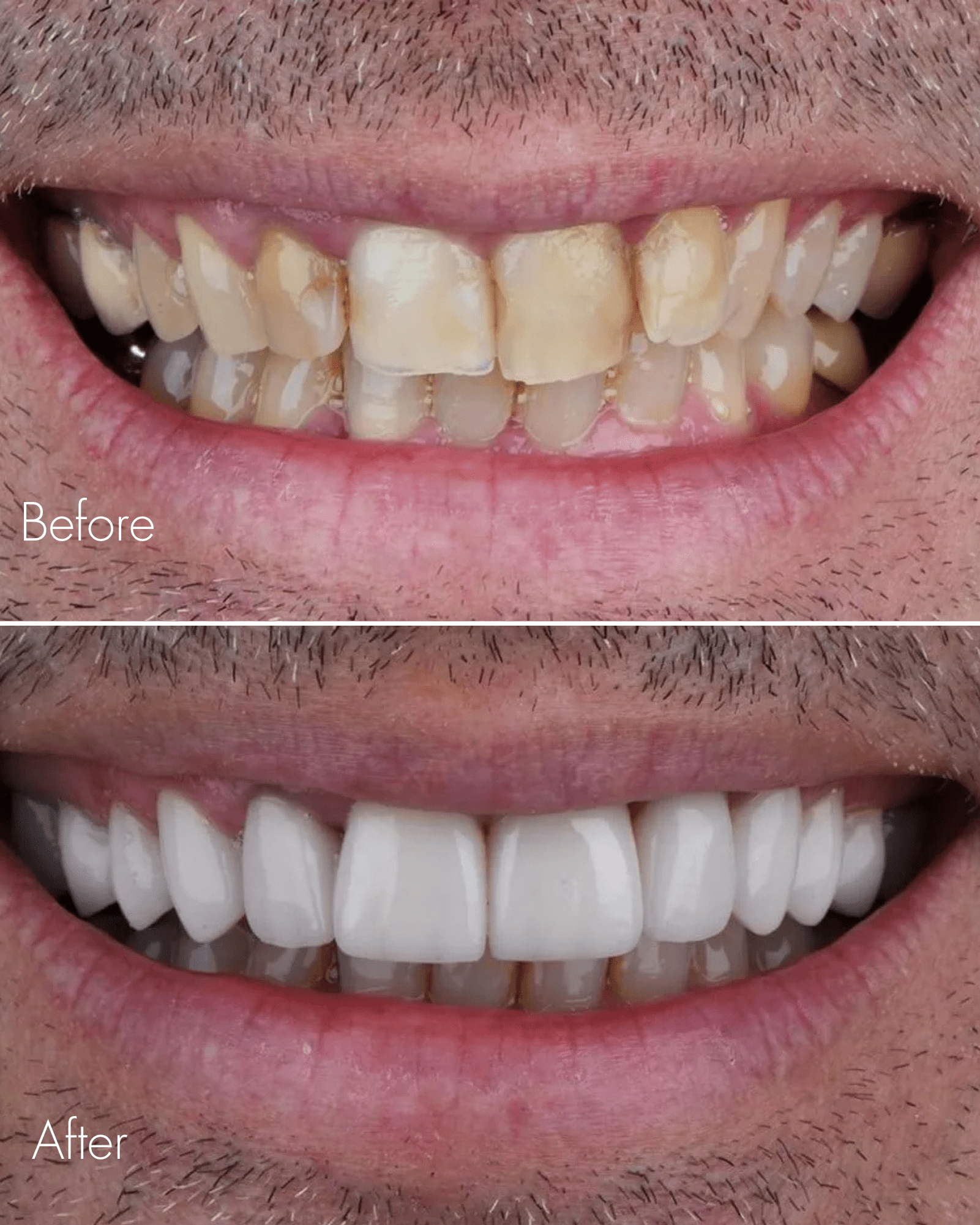 Dental Treatment Before After