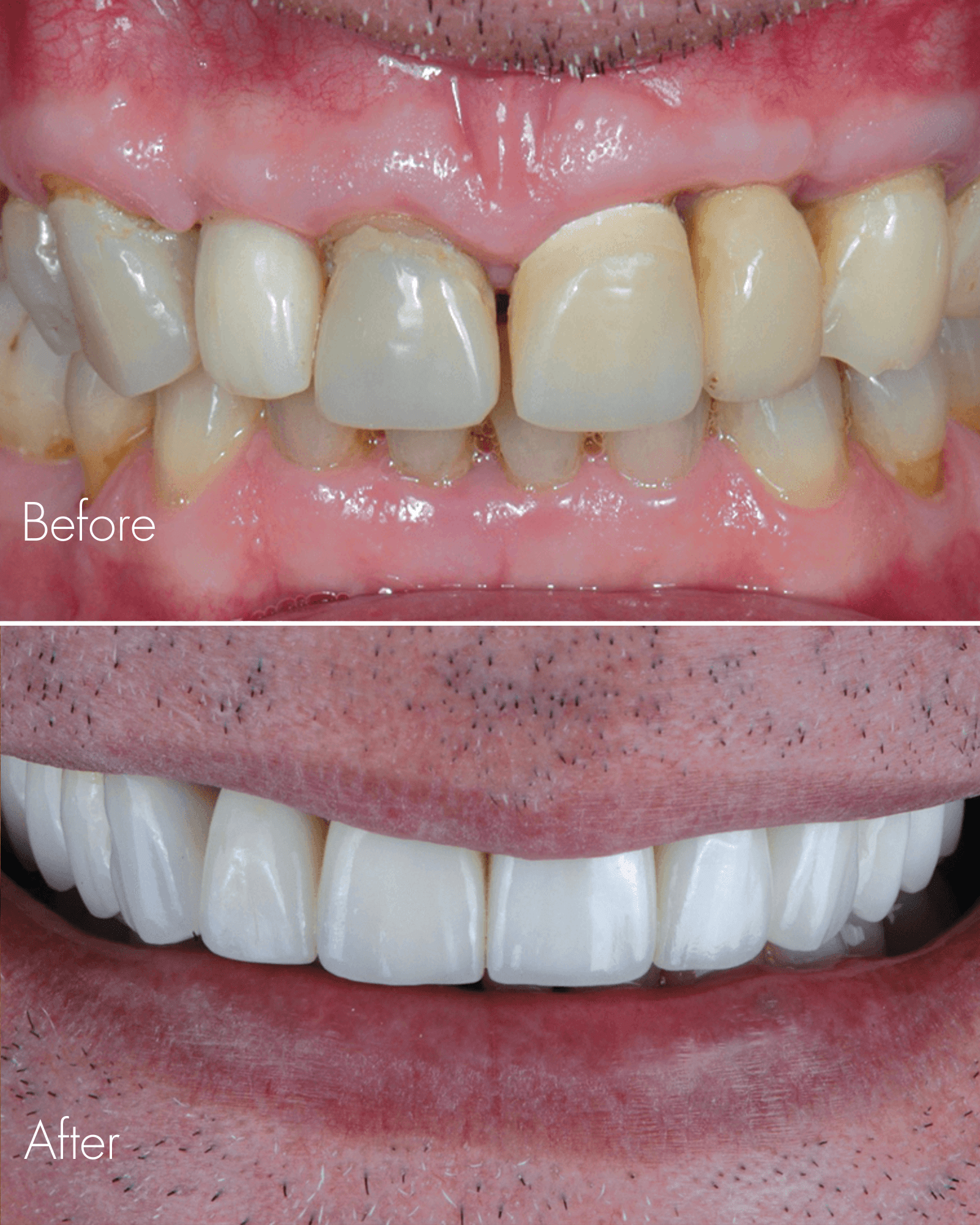 Dental Implant Before After