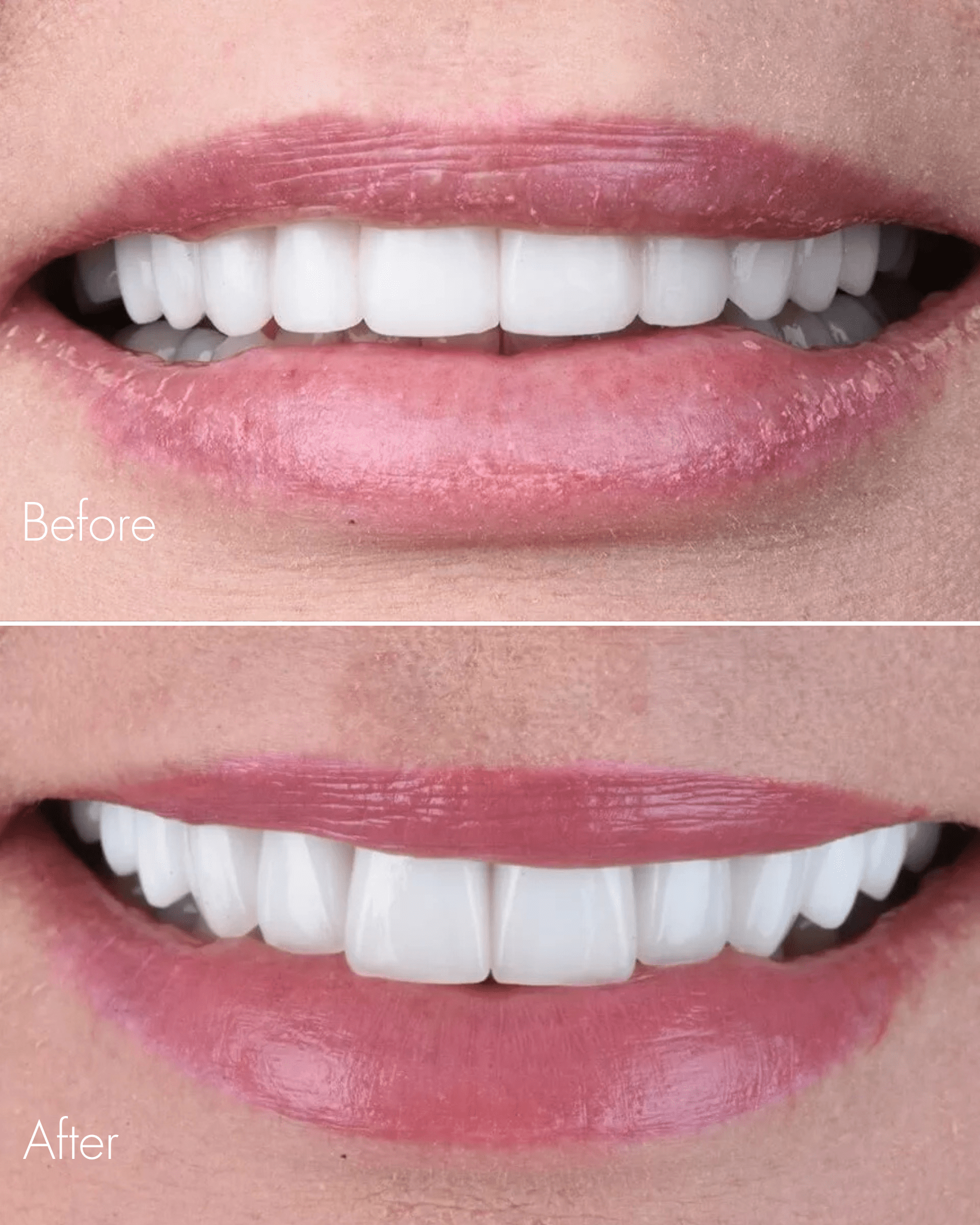 Enamel Repair Before After