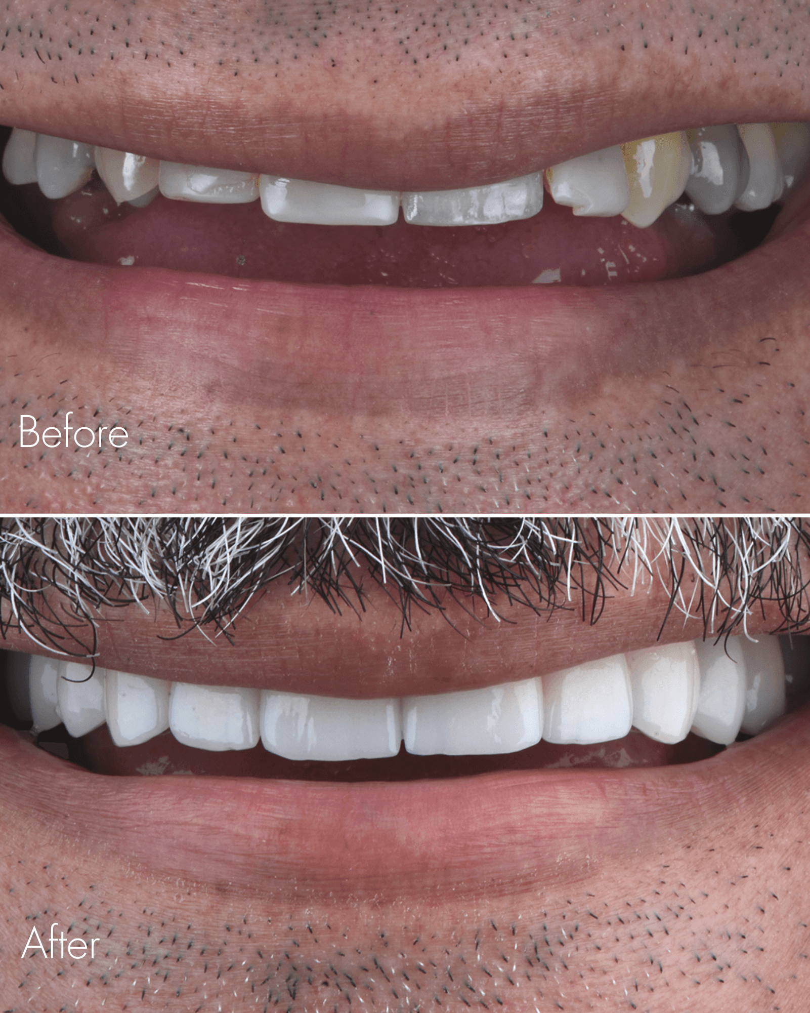 Dental Crown Before After