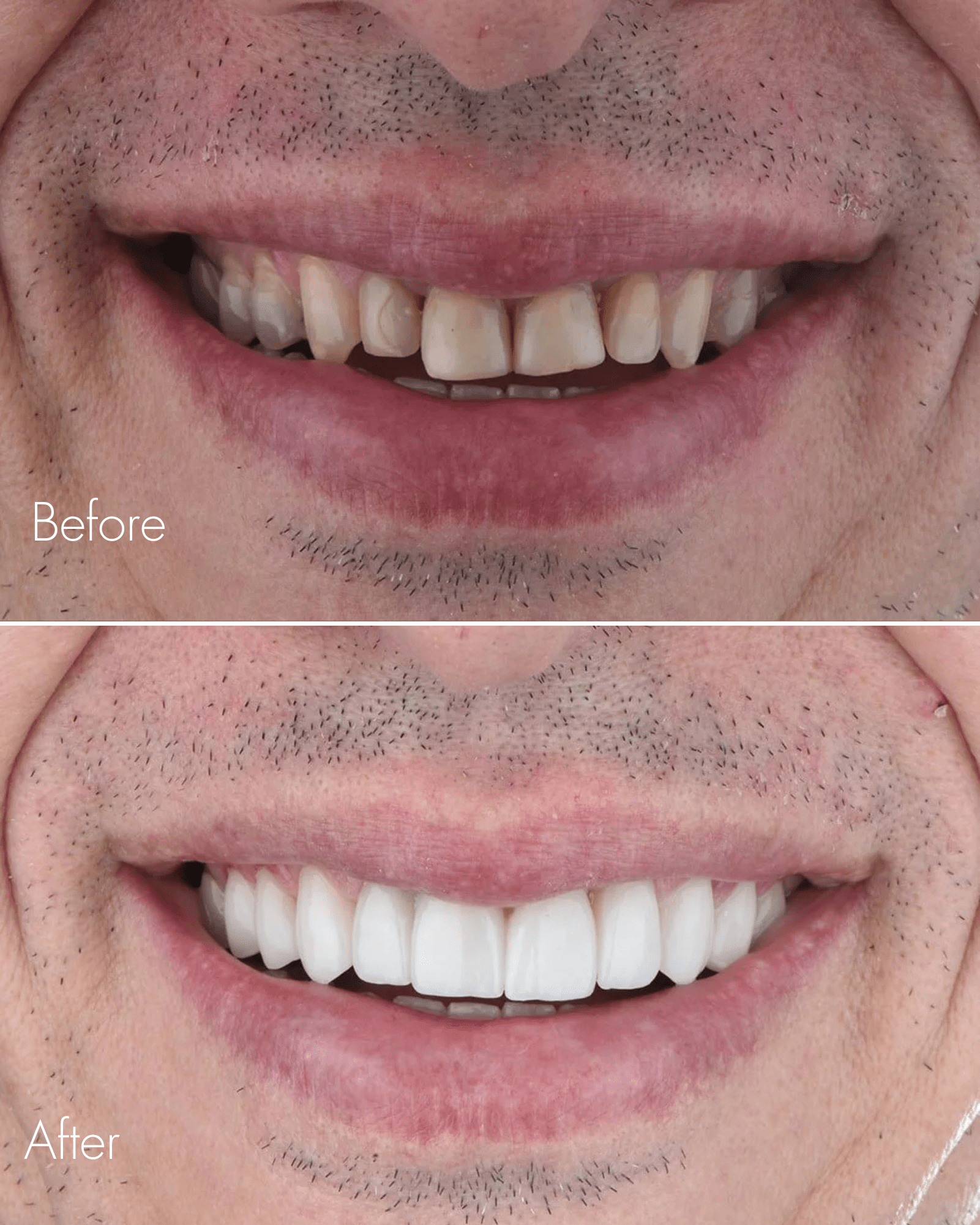 Smile Transformation Before After
