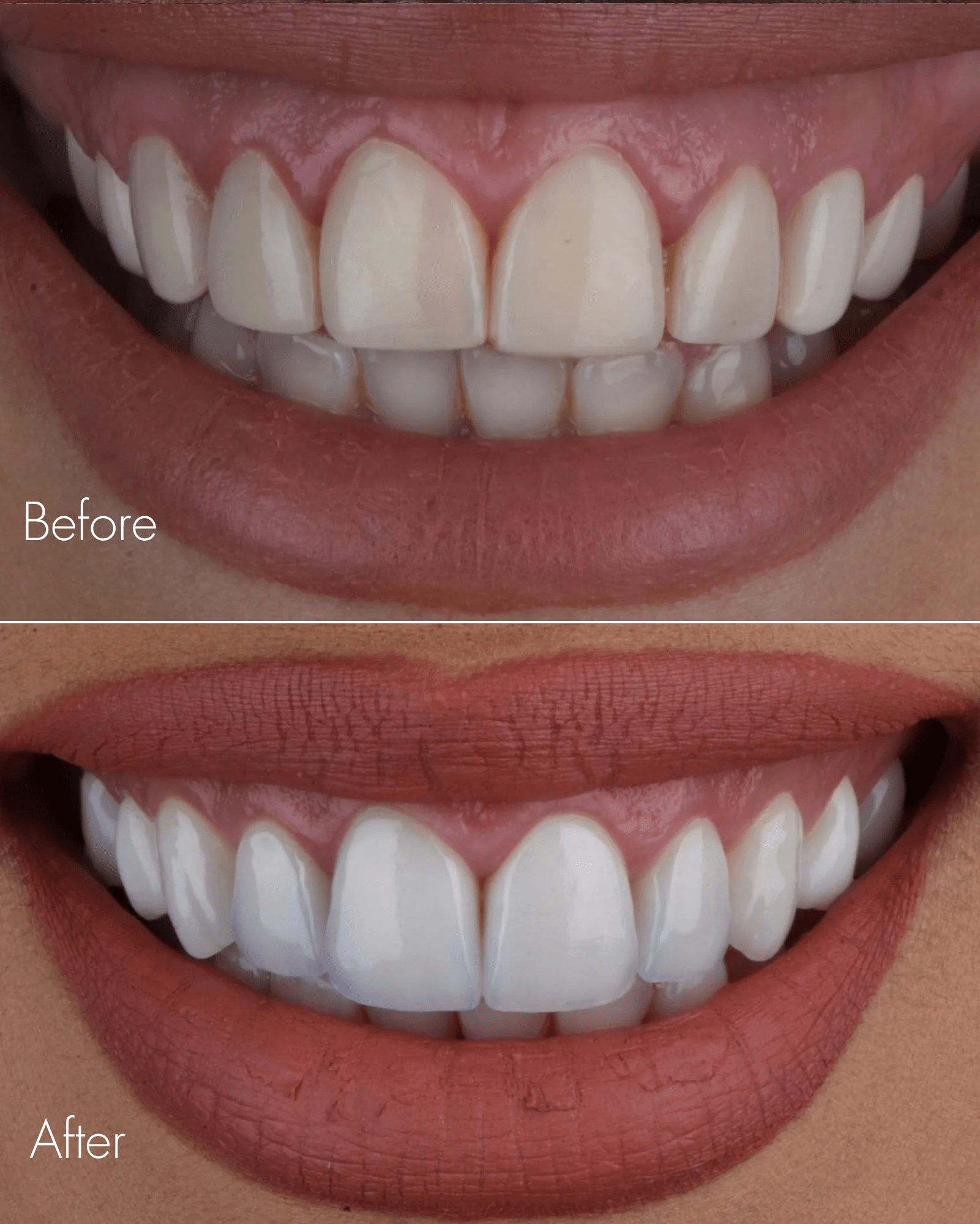 Smile Design Before After Result