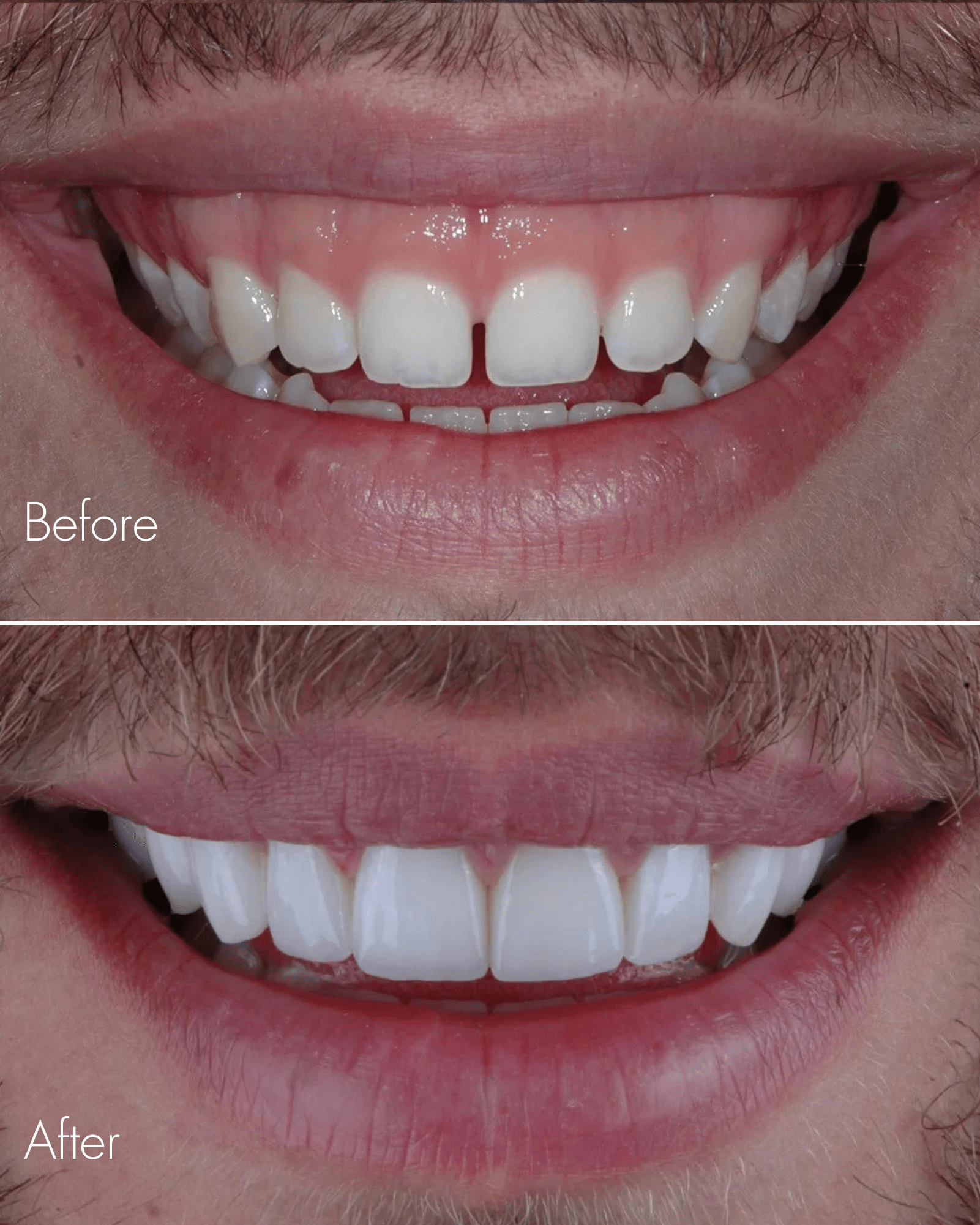 Tooth Repair Before After