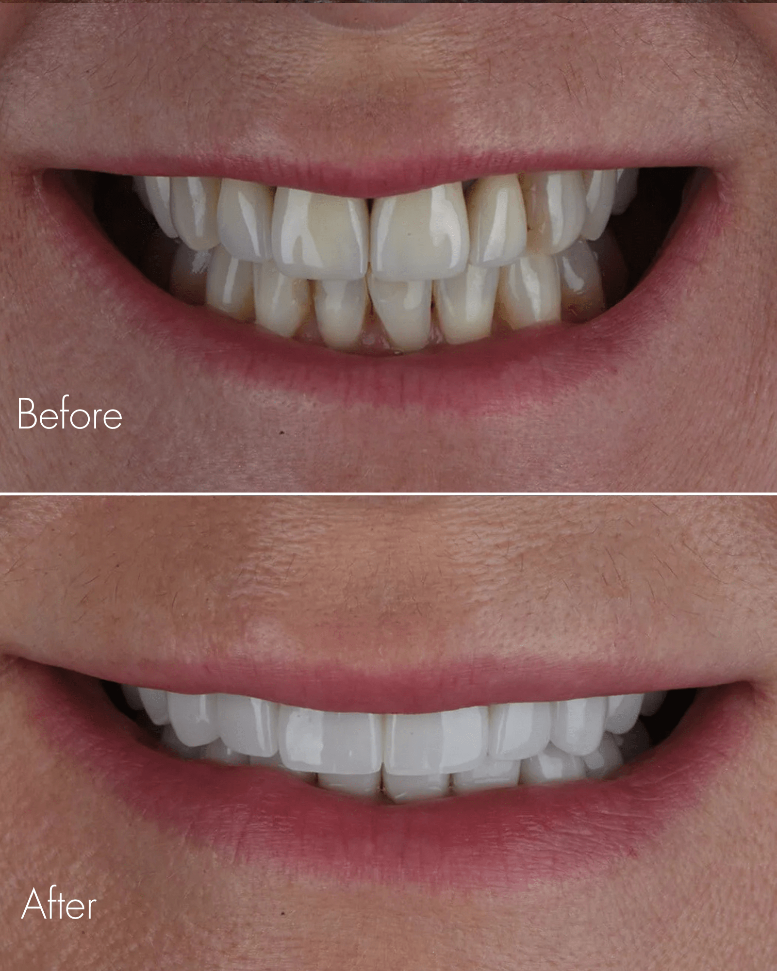 Porcelain Veneers Before After Smile
