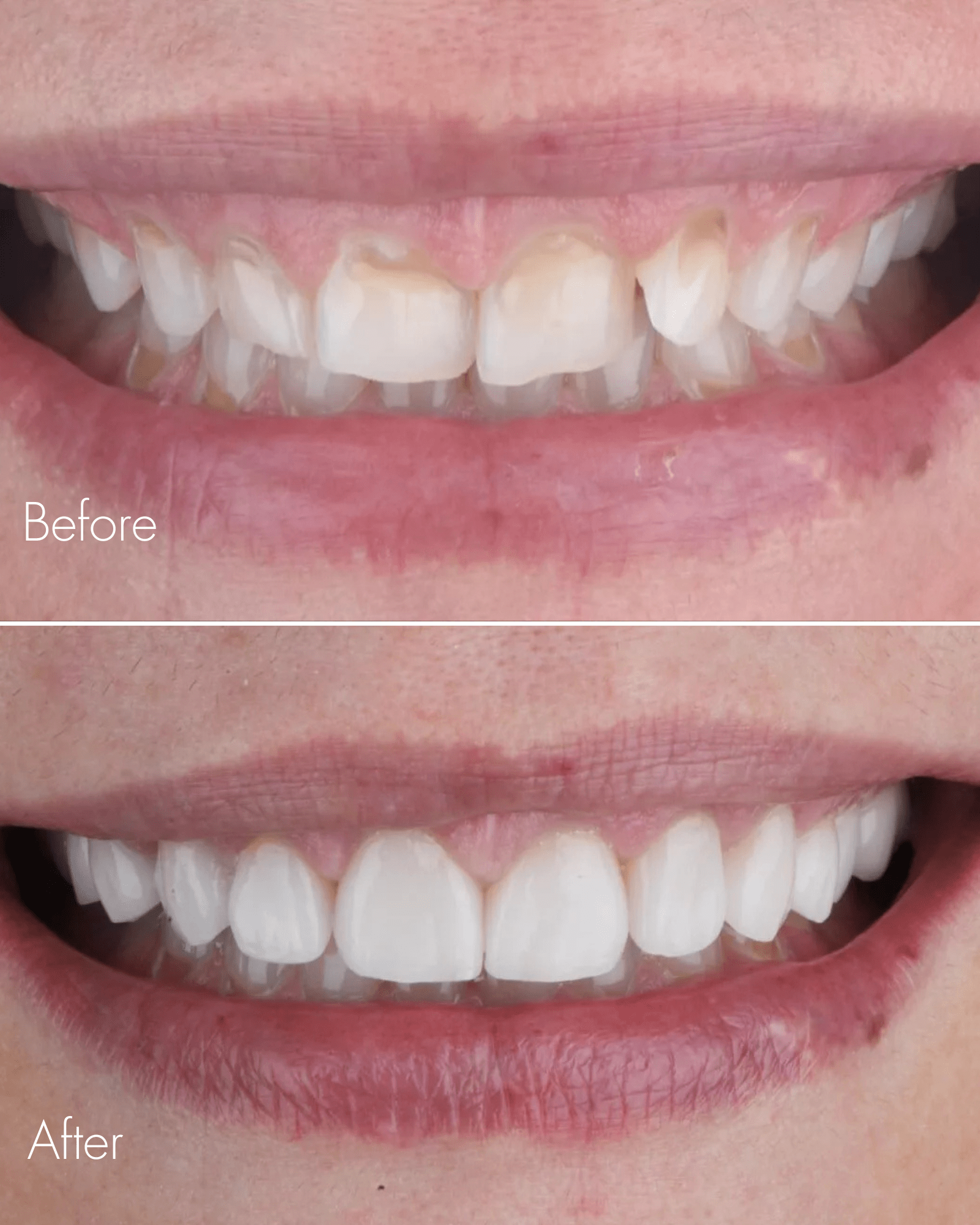 Teeth Restoration Before After