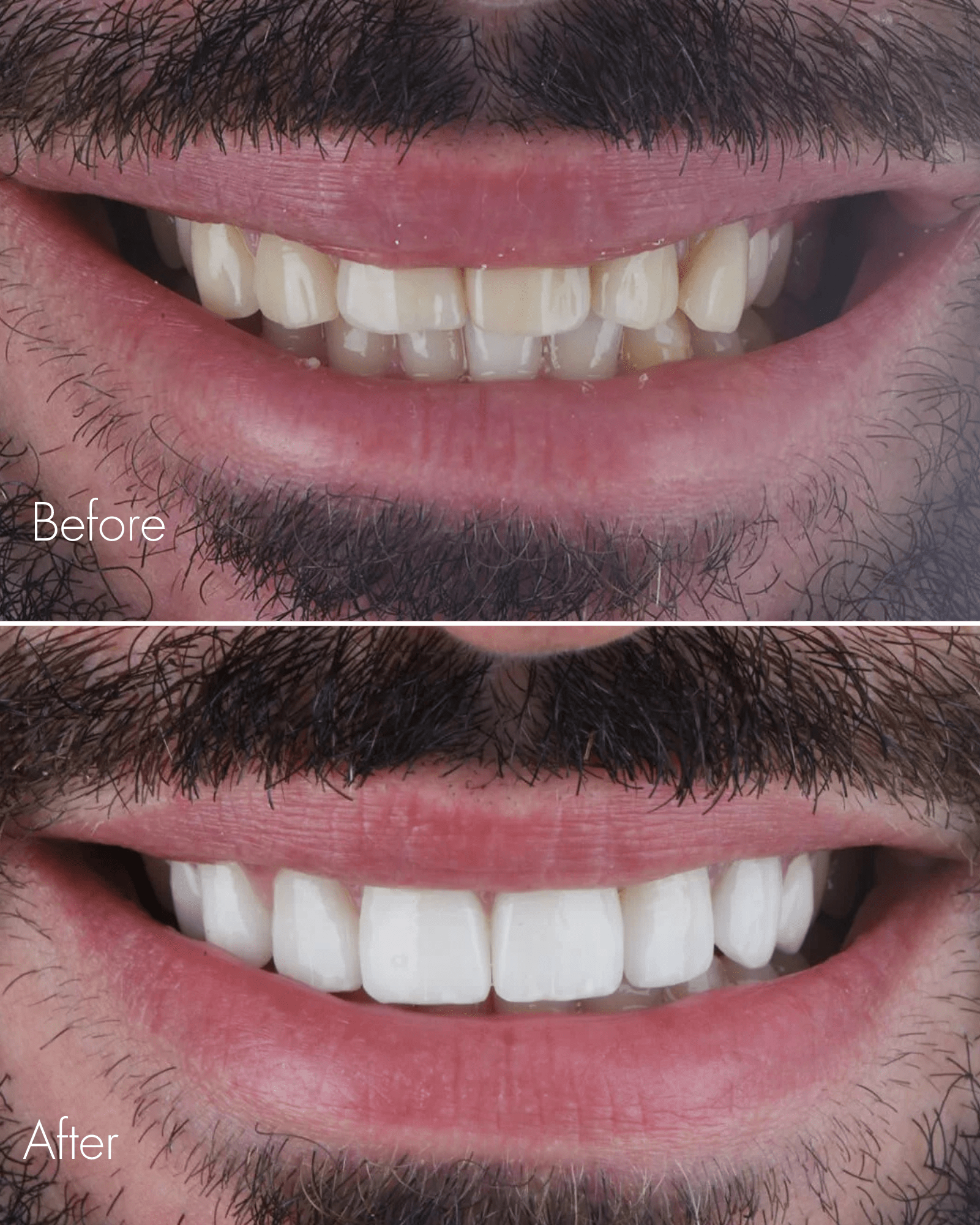 Gum Contouring Before After