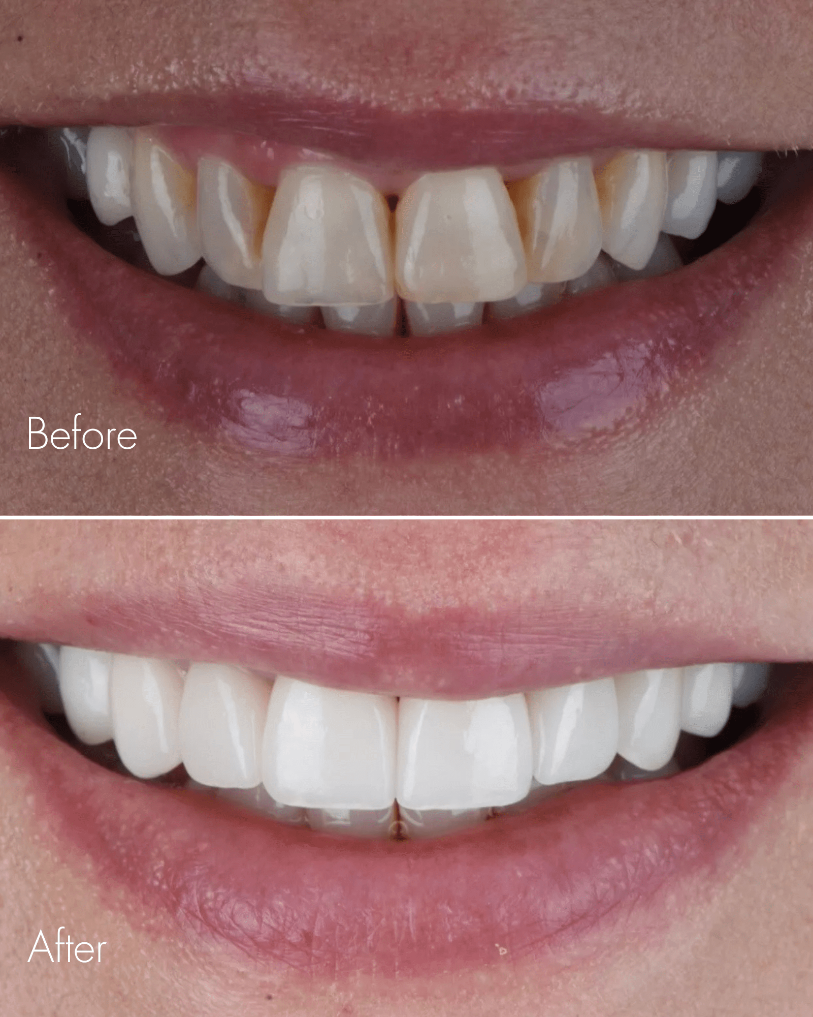 Teeth Gap Fix Before After