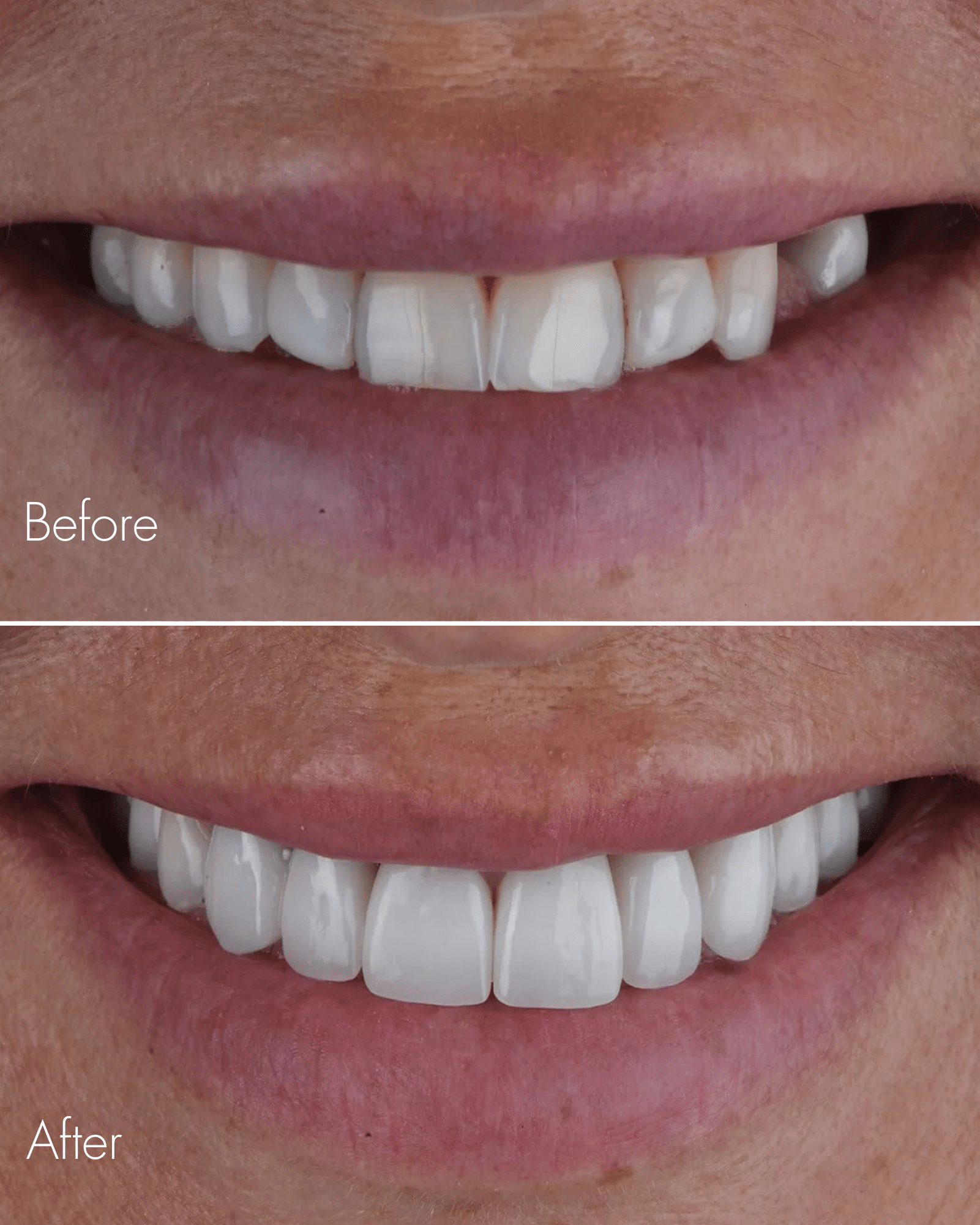 Teeth Whitening Before After Results