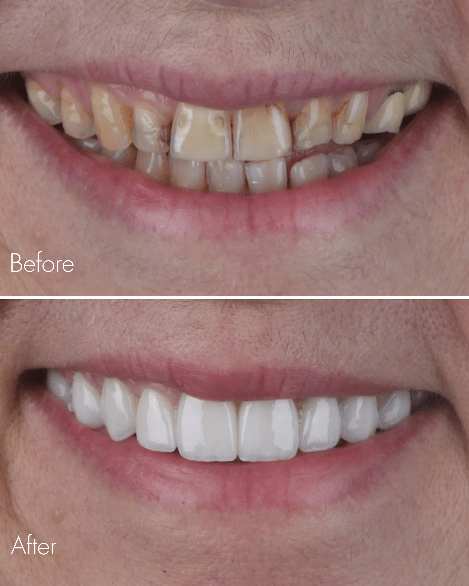 Composite Bonding Before After