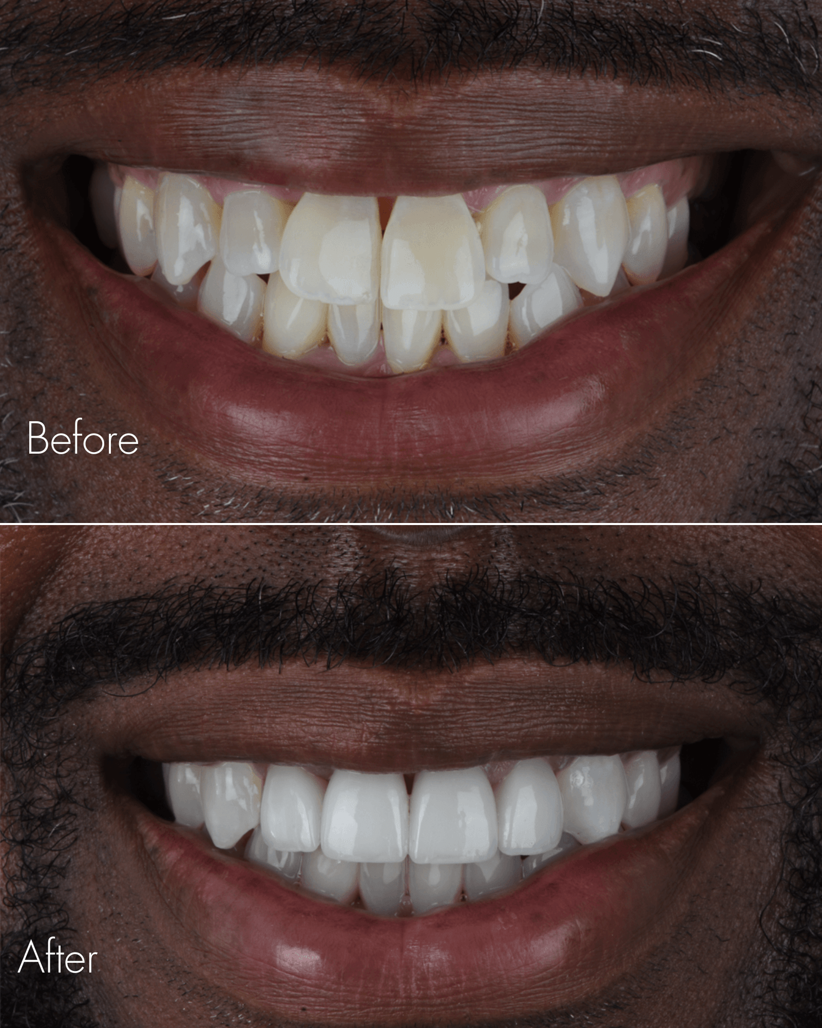 Dental Restoration Before After