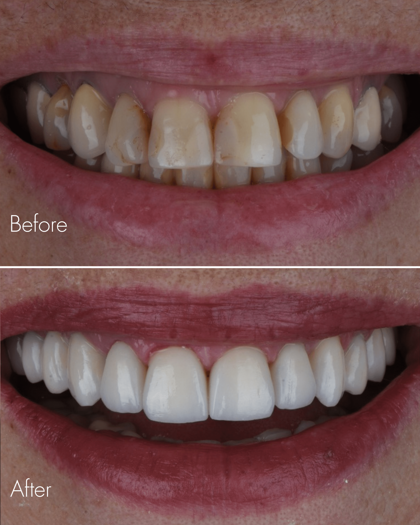 Full Mouth Restoration Before After