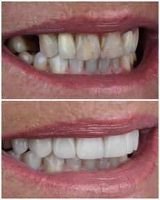 advantages of dental implants over dentures